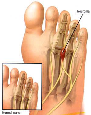 Morton's Neuroma diagram