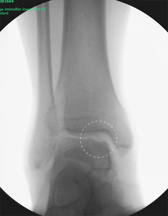 Mosaicplasty