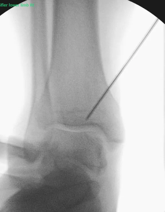 Mosaicplasty