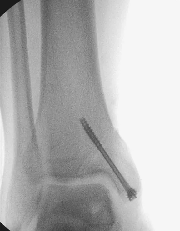 Mosaicplasty