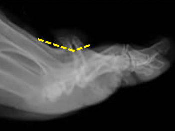 Open Cheilectomy Xray