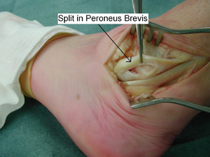 Peroneal Tendons