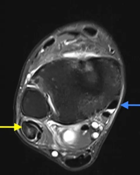 Abnormal Peroneal Tendon