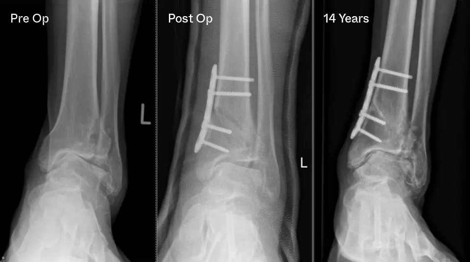 Ankle Arthritis