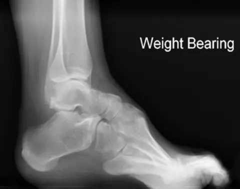 Cavus Foot Syndrome Xray