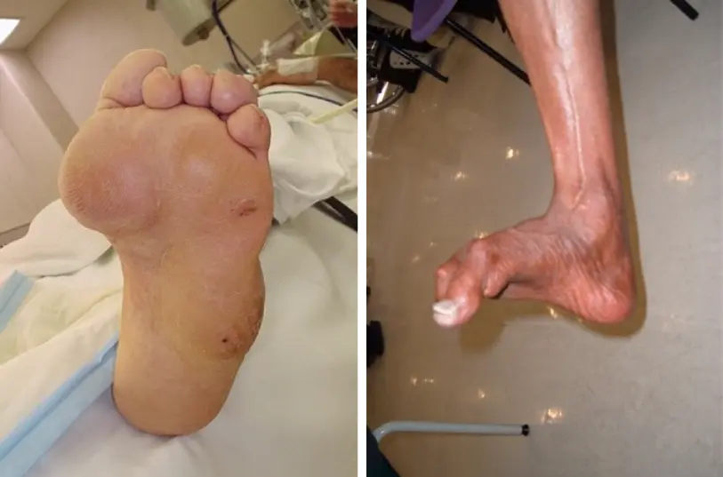 Clawed Toes and Metatarsalgia