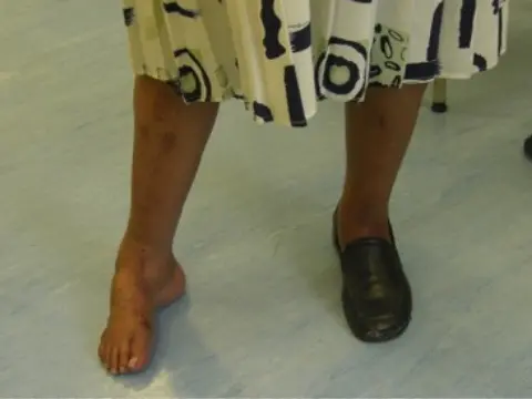 Pes Cavus foot shapee
