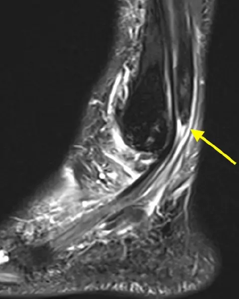 Ruptured Tendon