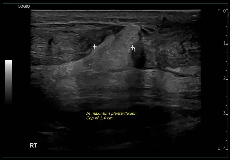 Achilles Tendon Ultrasound Scan