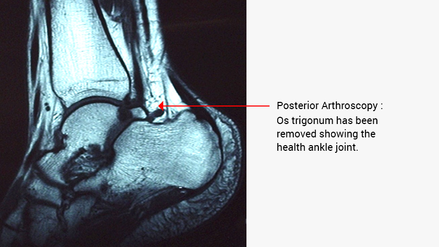 Posterior Arthroscopy Xray