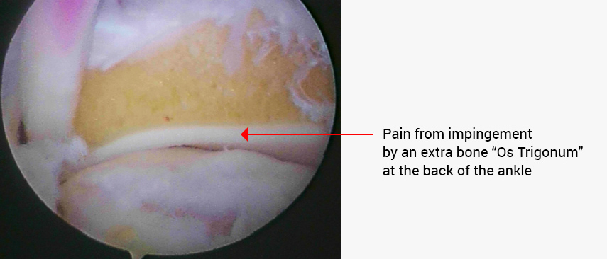 Posterior Arthroscopy