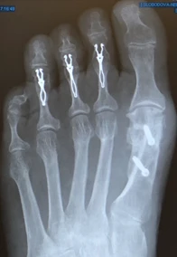 Small Toe Fusion