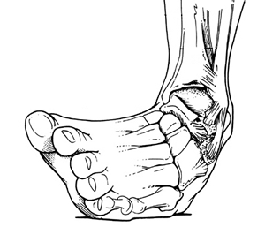 https://www.londonfootankle.co.uk/images/sprained-ankle.png