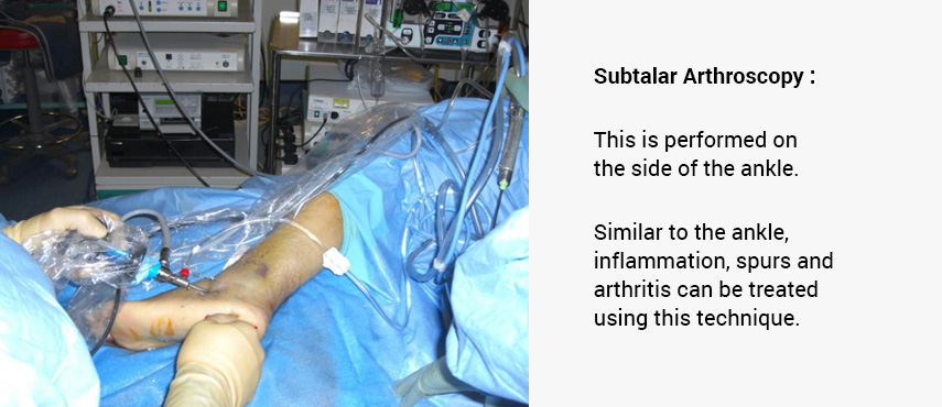 Subtalar Arthroscopy Surgery