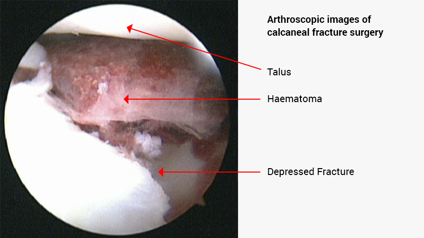 Subtalar Arthroscopy