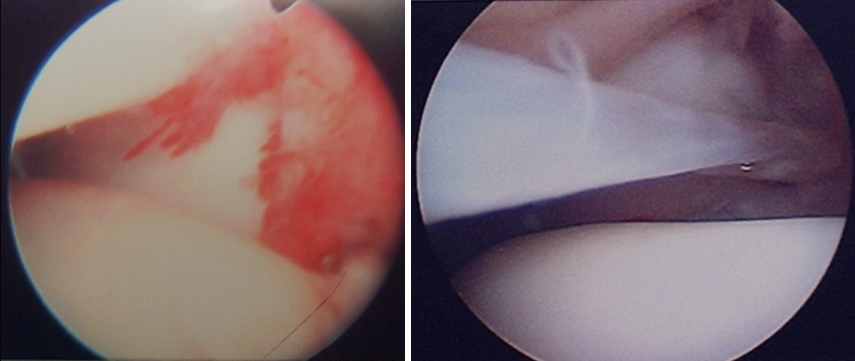 Synovitis / Scarring