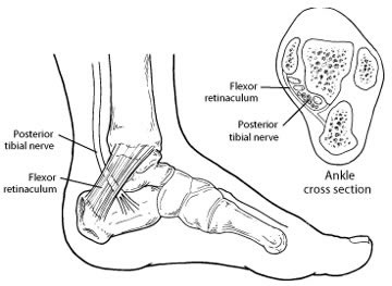 Tarsal Tunnel Syndrome