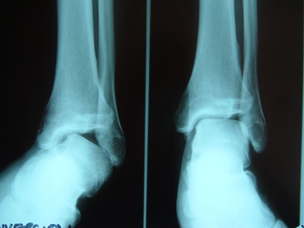 Xray showing Tibia, Fibula and Talus